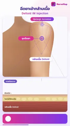 ภาพคลิปฉีดยาเข้ากล้ามเนื้อใน NurseMap