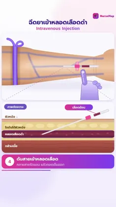 ภาพคลิปให้น้ำเกลือทางหลอดเลือดดำใน NurseMap
